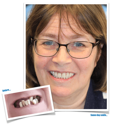before-after Predent Consultation Image